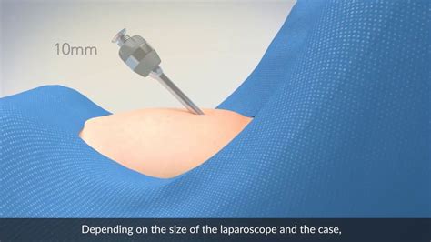 the needle drop testing|Abdominal entry in laparoscopic surgery.